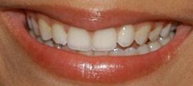 image of Victoria Justice's teeth