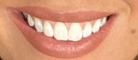 Picture of Victoria Larson teeth and smile