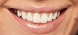 Picture of Victoria Larson teeth and smile