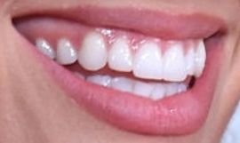 Picture of Wallis Day teeth and smile