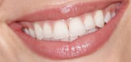 Picture of Wallis Day teeth and smile