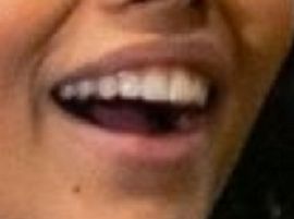 Picture of Whitney Peak teeth and smile