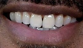 Picture of Will Smith teeth and smile