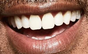 Picture of Will Smith teeth and smile