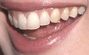 Picture of Winona Ryder teeth and smile