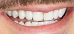 Image of Zac Efron's teeth and smile