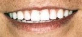 Picture of Zach Wilson teeth and smile