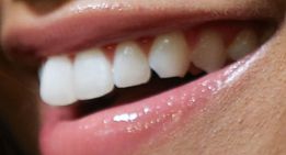 Image of Zendaya's teeth