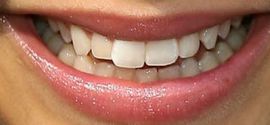 Image of Zendaya's teeth