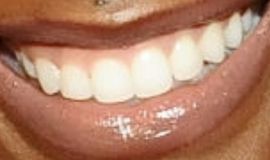 Picture of Zozibini Tunzi teeth and smile